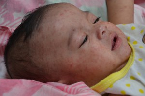 leetrid leetrivaktsiin mmr mumps punetised lastehaigused vaktsiin vaktsineerimine
